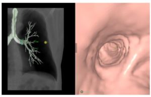 Lung Analysis